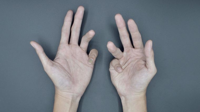 Dupuytren's disease of the hand